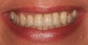 Figure 31  Final restorations in place. These are screw-retained to avoid cementation of deepened implant restorations.