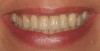 Figure 32  Appearance of smile with crown lengthening of No. 7 (manipulated image).