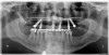 Figure 6  Postoperative panorex, “all-on-six” patient in Figure 5. Note proximity of angled posterior implants to anterior wall of maxillary sinuses. Surgery performed flaplessly.