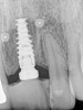 Figure 11  Postoperative PA radiograph, patient in Figure 8 through Figure 10.