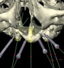 Figure 18  Severe maxillary atrophy and defect created from long-term chronic infections from subperiosteal implant; overdenture restoration planned.