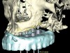 Figure 20  Virtual implant placement, partial reconstruction with bone morphogenic protein secondary to myxoma resection, maxilla.
