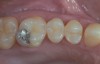 Figure 1  Intraoral view of a failing amalgam restoration (Figure 1). Selection of the proper bonding agent and restorative material enables long-lasting clinical outcomes. Postoperative view (Figure 2).