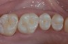 Figure 2  Intraoral view of a failing amalgam restoration (Figure 1). Selection of the proper bonding agent and restorative material enables long-lasting clinical outcomes. Postoperative view (Figure 2).