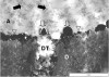 Figure 3  Transmission electron photomicrographs (TEM) of resin-dentin interfaces of one-step self-etch adhesives with water-filled areas and droplets. A = Adhesive; D = Dentin; H = Hybrid Layer; DT = Dentin Tubule. G-Bond (Figure 3); Adper Prompt L-Pop (Figure 4).