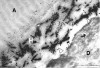 Figure 4  Transmission electron photomicrographs (TEM) of resin-dentin interfaces of one-step self-etch adhesives with water-filled areas and droplets. A = Adhesive; D = Dentin; H = Hybrid Layer; DT = Dentin Tubule. G-Bond (Figure 3); Adper Prompt L-Pop (Figure 4).