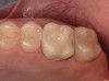 Figure 1  Well-adapted and anatomically contoured provisional restoration maintaining periodontal health.