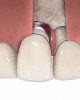 Figure 1  Critical bone and soft tissue relationships: The position of the buccal bone crest is approximately 3 mm from the gingival zenith of the natural tooth. Recapitulation of this architecture for ideal single-tooth implant esthetics requires that the adjacent bone crest approximate this level in three dimensions. Implant placement at the crest will support the formation of 3 mm of supracrestal buccal soft tissue, which embodies the suclus and the junctional epithelium/connective tissue contact along a titanium or zirconia abutment.