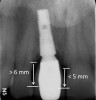 Figure 5  Characterization of the interproximal bone and tooth contacts: A periapical radiograph assists in measuring the distance from bone crest to the adjacent tooth contact points for missing tooth No. 8. The mesial bone crest to the adjacent tooth contact distance is < 5 mm, while the distal bone crest to adjacent tooth contact distance is > 6 mm (Fig 4). One-year following implant placement, conservation of these dimensions is revealed (Fig 5). The clinical photograph (Fig 6) of the lateral incisor adjacent to tooth No. 8 implant crown demonstrates that the absence of distal interproximal (papilla) fill related to the observed bone crest to contact distance exceeds 6 mm.