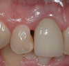 Figure 6  Characterization of the interproximal bone and tooth contacts: A periapical radiograph assists in measuring the distance from bone crest to the adjacent tooth contact points for missing tooth No. 8. The mesial bone crest to the adjacent tooth contact distance is < 5 mm, while the distal bone crest to adjacent tooth contact distance is > 6 mm (Fig 4). One-year following implant placement, conservation of these dimensions is revealed (Fig 5). The clinical photograph (Fig 6) of the lateral incisor adjacent to tooth No. 8 implant crown demonstrates that the absence of distal interproximal (papilla) fill related to the observed bone crest to contact distance exceeds 6 mm.