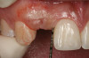 Figure 10  Clinical examination of the bound edentulous space: Measurement of the distal (Fig 10) and mesial (Fig 11) interproximal tissue height using a periodontal probe supplements data obtained from the periapical radiograph. Estimation of the buccal tissue thickness (bone sounding) is performed at the determined location of the gingival zenith using a guide developed from the diagnostic waxing (Fig 12).