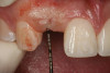 Figure 12   Clinical examination of the bound edentulous space: Measurement of the distal (Fig 10) and mesial (Fig 11) interproximal tissue height using a periodontal probe supplements data obtained from the periapical radiograph. Estimation of the buccal tissue thickness (bone sounding) is performed at the determined location of the gingival zenith using a guide developed from the diagnostic waxing (Fig 12).