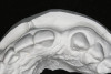 Figure 13   Exploiting study casts for planning single-tooth implant placement and restoration: Mounted study casts permit an estimation of available bone volume (Fig 13); measure the bound edentulous space inter-tooth dimensions (Fig 14); measure the available inter-arch dimension (restorative space) (Fig 15); and evaluate alveolar ridge/tooth relationships (distance from zenith represented by plastic stent to ridge crest) (Fig 16).