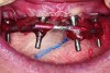 Fig 5. Impression-taking with splinted impression copings with autopolymerizing resin and wire.