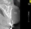 Figure 18    Volumetric characterization of the residual alveolar ridge using CBCT: Fig 17 The coronal section of the maxilla reveals the cortical structure of the alveolar ridge associated with the missing right central incisor at the mid-root level. The buccal plate is identifiable and is characterized by little resorption. Fig 18  The saggital section of the maxillary alveolar ridge is displayed in relationship to the planned contour of the eventual implant crown. Fig 19 Importing DICOM files into planning software permits evaluation of the implant, abutment, and crown relationships with existing bone. These images readily characterize both the possible 6-mm mesiodistal width and the possible displacement of the implant 3-mm apical and 2-mm palatal to the planned gingival zenith.