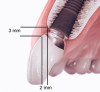 Figure 20  The 3/2 rule for implant placement: This geometric guideline indicates that the implant/abutment interface should be located 3 mm apically from the gingival zenith and displaced palatally 2 mm. It serves as a planning guide to identify sufficient bone in this location for ideal implant placement. When deviations of greater than 1 mm to 1.5 mm are required because insufficient bone is present, bone augmentation may be considered.