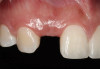 Figure 21   Gingival zenith planning: The location of the gingival zenith for this missing lateral incisor is not fully evident during initial clinical evaluation (Fig 21). Subsequent diagnostic waxing reveals the position of the planned gingival zenith (Fig 22). A thermoplastic template captures the position of the zenith and enables transferring this location to the clinical environment (Fig 23 and Fig 24). Final crown contours are defined by soft-tissue form (Fig 25).