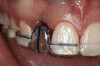 Figure 24  Gingival zenith planning: The location of the gingival zenith for this missing lateral incisor is not fully evident during initial clinical evaluation (Fig 21). Subsequent diagnostic waxing reveals the position of the planned gingival zenith (Fig 22). A thermoplastic template captures the position of the zenith and enables transferring this location to the clinical environment (Fig 23 and Fig 24). Final crown contours are defined by soft-tissue form (Fig 25).