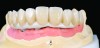 Fig 10. The full-arch zirconia framework with individual lithium-disilicate crowns, which were individually luted in the laboratory.