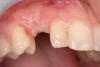 Figure 1  In Case 1, the patient’s edentulous site appeared healthy, with significant keratinized mucosa in the canine position.