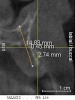 Figure 2 Cone-beam CT scan revealed severe horizontal bone deficiency in the proposed implant position.