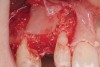 Figure 5  Small portion of rhBMP-2-seeded ACS was placed over the buccal portion of the mesh to contain FDBA particles.