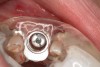 Figure 9  Primary stability of the implant achieved, facilitating a transmucosal healing approach.