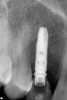 Figure 12  Periapical radiograph of the temporary restoration.