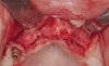 Figure 15  Full-thickness flap revealed severe bone loss, particularly in right canine–lateral incisor region.