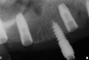 Figure 20  Post-placement periapical radiographs.