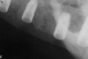 Figure 21  Post-placement periapical radiographs.