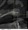 Figure 24  Postoperative CT scan demonstrated horizontal bone regeneration.