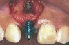 Fig 4. Implant inserted into the ridge, buccal view. There was a large labial concavity. The implant is seen on the buccal and terminates within the alveolar bone.