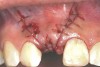 Fig 7. Vertical releasing incisions sutured to attain primary closure, buccal view.