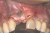 Fig 9. This image shows an example of vertical releasing incisions that are extended laterally across the mucogingival junction of adjacent teeth to attain better access and facilitate large graft procedures.

Fig 10. Case 2: Missing tooth No. 7 was extracted 3 months before implant placement.