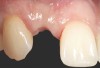 Fig 10. Case 2: Missing tooth No. 7 was extracted 3 months before implant placement.