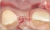 Fig 11. A horizontal releasing incision across the edentate ridge; it terminates 1 mm from the adjacent teeth.