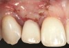 Fig 17. Vertical and horizontal incisions were sutured to attain primary closure.