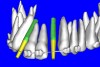 Figure 9b  Virtual implants were placed to determine the appropriate shape and type for the available space, in this case a tapered design allowed for adequate mesial-distal distance between adjacent roots.
