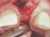 Fig 20. Papillae-sparing incisions were developed both horizontally and vertically. The pedicle flap was elevated, exposing a thin ridge.