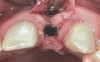 Fig 21. A dental implant was placed at the site of tooth No. 10. A defective buccal ridge was noted.