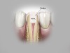 Fig 2. Sealer selection may influence the outcome of endodontic treatment. Ca(OH)2 has a high pH, is insoluble in alcohol, and is chemically classified as a strong base.