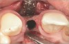 Fig 14. Implant placed into the thin ridge of bone, occlusal view.