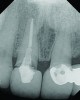 Fig 2. Periapical radiograph revealing the fractured central incisor.