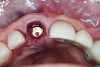 Fig 8. After placement of a cover screw, bone graft material was packed into the gap between the implant and the buccal wall.
