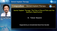 Dental Implant Therapy: The Fate of Buccal Plate and the Aesthetic Ramifications Webinar Thumbnail