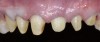 Fig 5. Preparation of maxillary anterior tooth segment to control vertical dimension of occlusion.