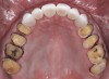 Fig 8. Maxillary occlusal view of cemented anterior full-contour high-translucent zirconia crowns and refined conservative preparations of posterior teeth for onlays and crowns.