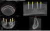 Fig 1. CBCT image of the mandible with implants superimposed