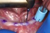 Fig 3. Simplified “flapless” 1.2-mm-wide and 10-mm-deep osteotomy using surgical handpiece and copious irrigation at 1200 rpm. The underlying bone shape is felt with the non-dominant hand to guide handpiece angulation.